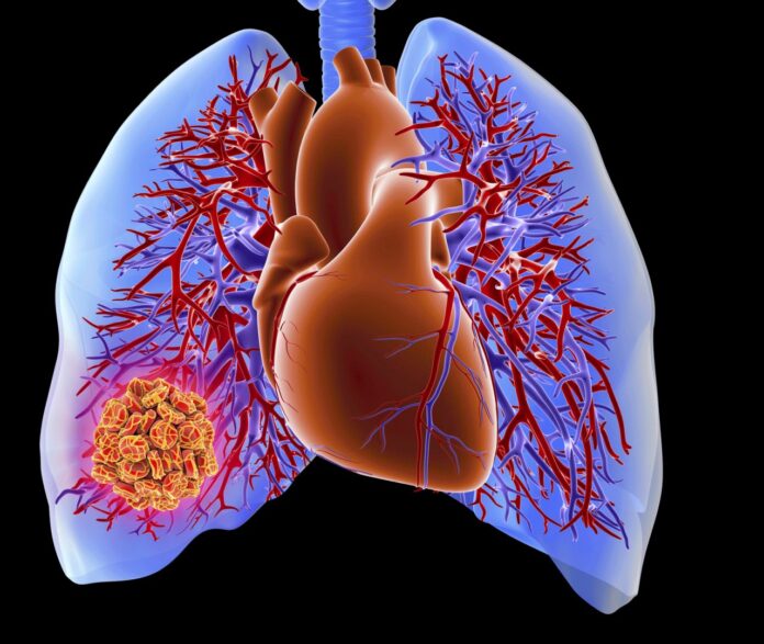 2026 AHA/ACC Guideline for the Management of Acute Pulmonary Embolism