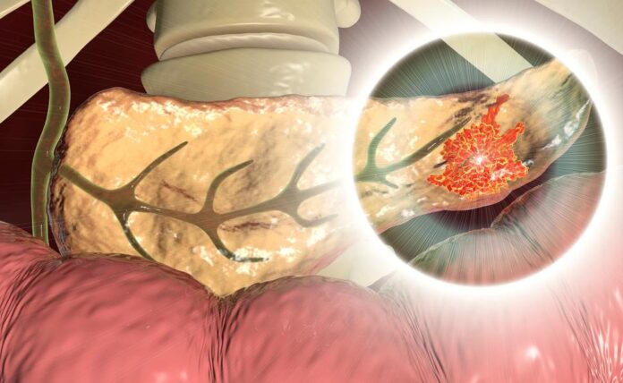 pancreatic cancere
