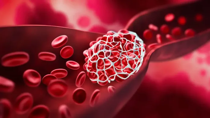 ASH ISTH 2026 Guideline: Anticoagulant Prophylaxis for Venous Thromboembolism (VTE) in the Pediatric Population